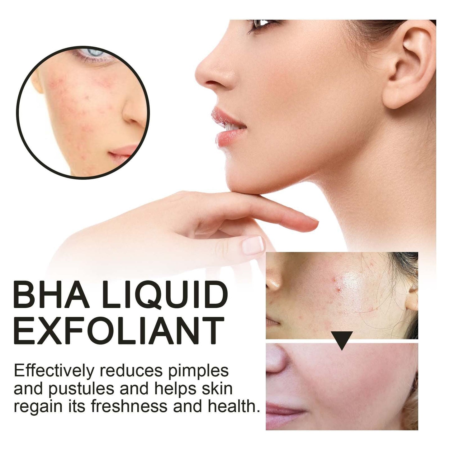 BHA Liquid Exfoliant, Lightening Acne Seal Pore-Tightening And Moisturizing Skin Essence