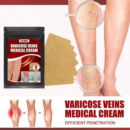 Aricose Veins Medical Cream, Relieve Leg Swelling Earthworm Leg Vein Massage To Relieve Pain