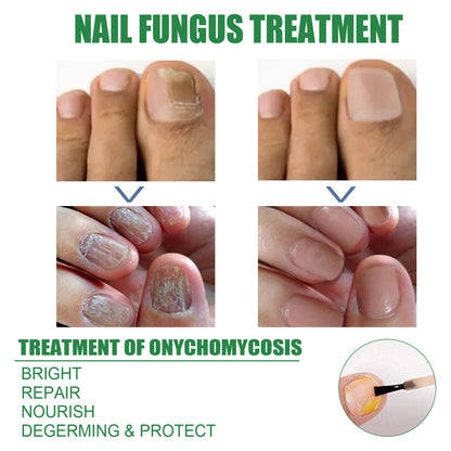 Nail Repair Solution Tea Tree Oil Essence Gentle Nourishing Manicure Cleansing Soft Nail Care Solution