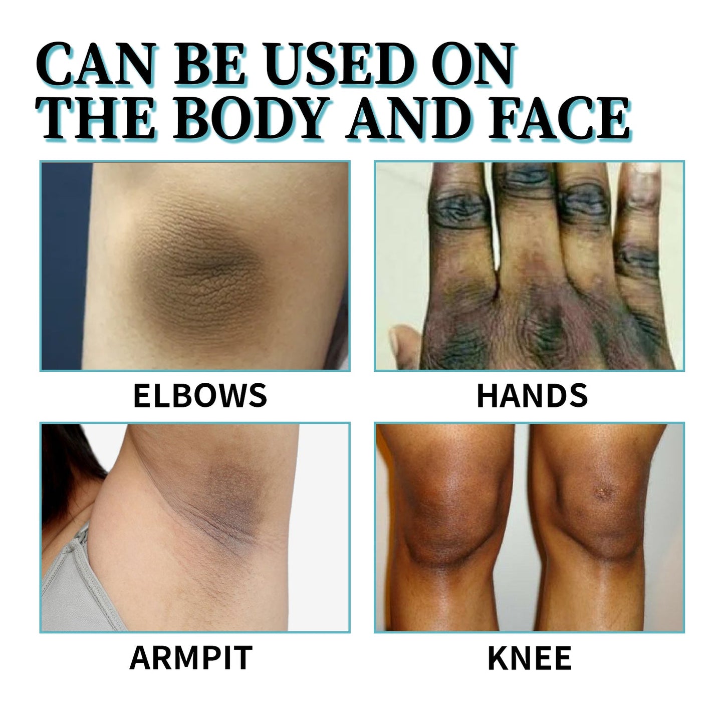 Acanthosis Nigricans Therapy Lotion, Skin Moisturizing Clean Black Dark Heavy Alar Knee Joint Repair Carry Bright Color Of Skin