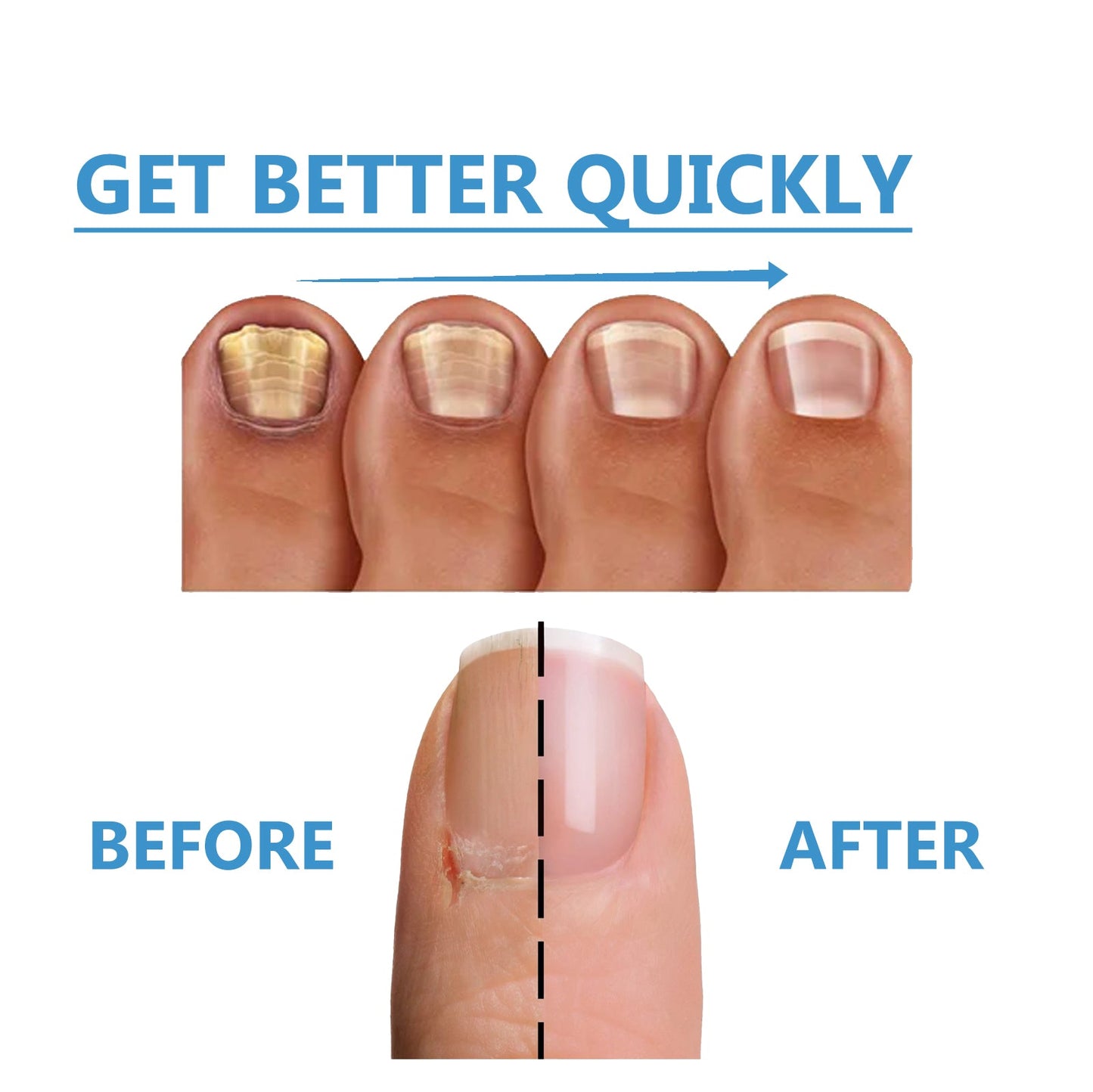 Nighttime Fungal Nail Treatment Patch, Repair Hand And Foot Inlay Rotten Nails Thickening Gray Nail Polish Care Patch