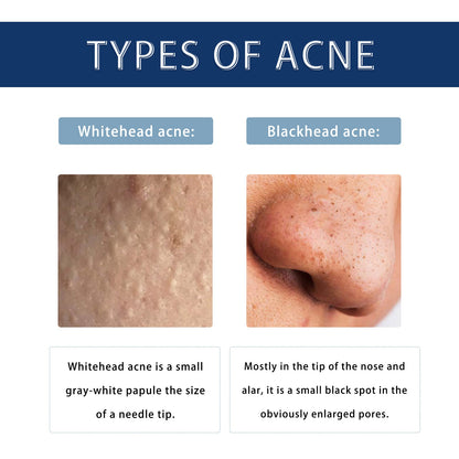 Anti-Pimple Drying Lotion, Facial Cleansing And Repair Lighten Acne Marks And Pits, Close Your Mouth And Mild Skin Cream