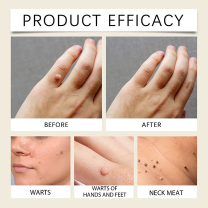 Mole And Wart Care Cream, Soft And Smooth Skin Moisturizing And Repairing Skin Care Cream
