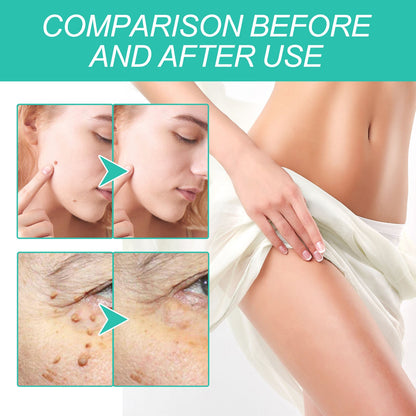 Keyu Liquid Repair Smooth Face Body Skin Deep Cleaning Moles Corns Keyu Liquid Pen