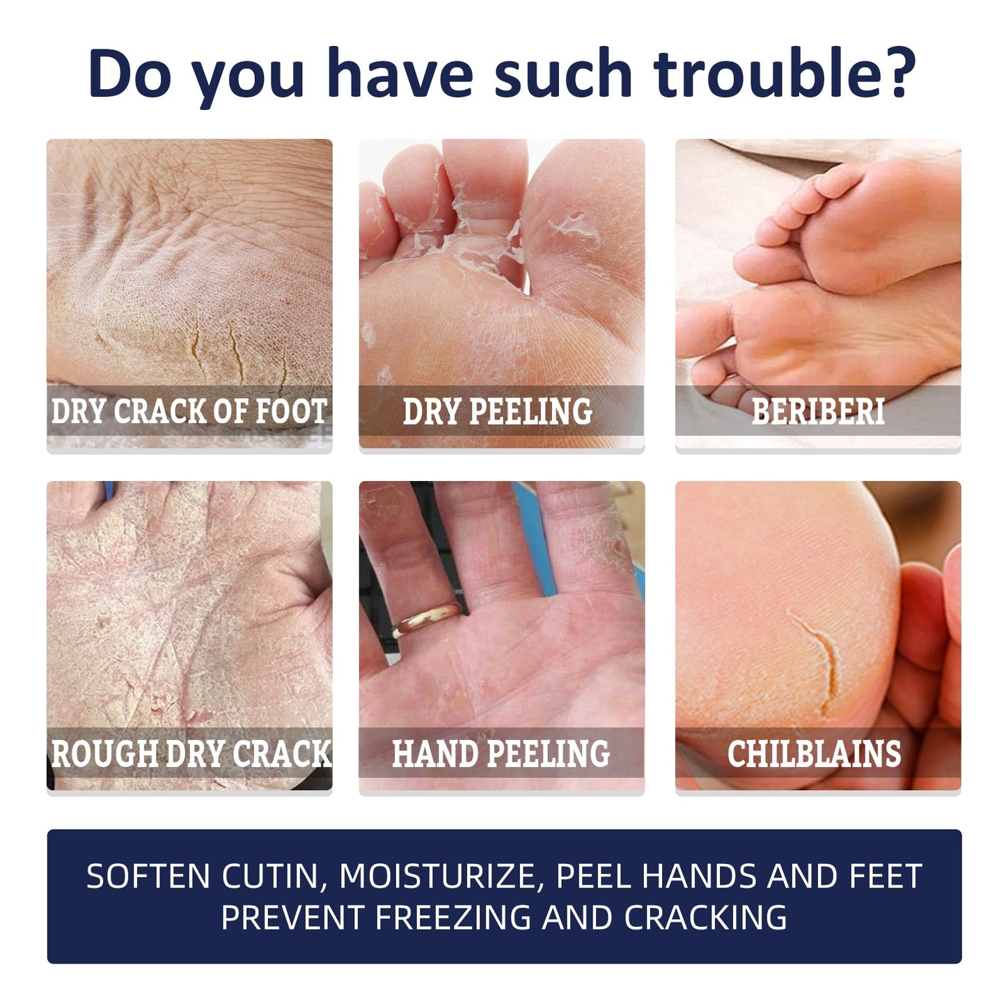 Anti-Crack Repair Hand Cream, Improves Cracked Rough Skin, Removes Dead Skin And Hydrates Hands And Feet Cream