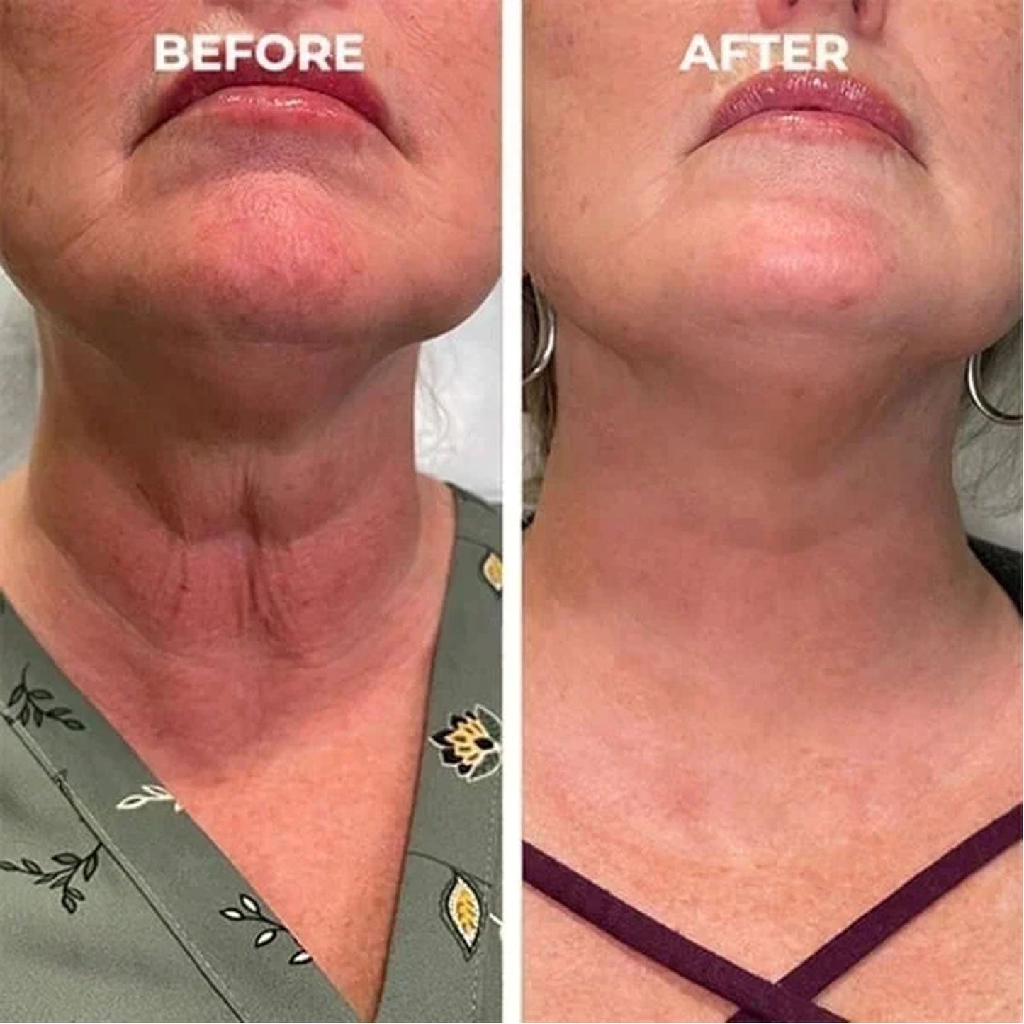 Facial Essence, Lifts And Tightens Facial Skin And Reduces Fine Lines And Wrinkles