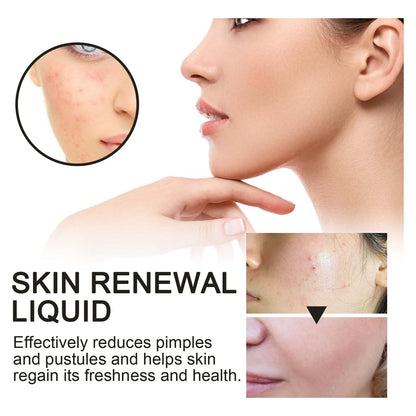 Skin Renewal Liquid, Reduce Acne Print Repair Acne Muscle Mild Clear Acne Hydrating Essence